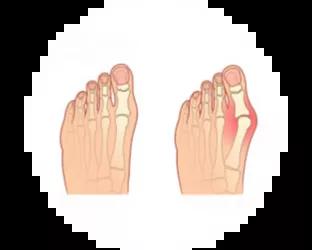 Hallux Valgus fot